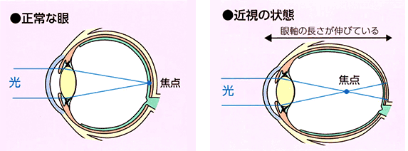 正常な眼と近視の状態の図