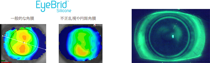 一般的な角膜、不正乱視や円錐角膜の写真