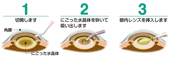 横浜市戸塚　眼科　とつか眼科　白内障日帰り手術内容　１．切開　２．にごった水晶体を砕いて吸出し　３．眼内レンズを挿入