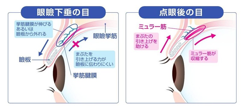 眼瞼下垂の目と点眼後の目の比較