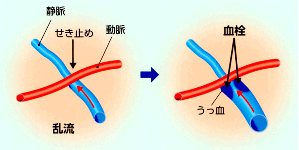 静脈が閉塞するしくみ