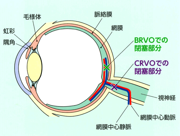 BRVOでの閉塞部分