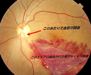網膜静脈閉塞症の眼底写真