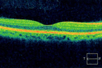 正常な目の網膜断層