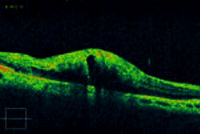 網膜静脈閉塞症の網膜断層