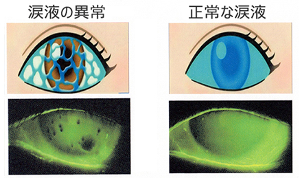 涙液の異常と正常な涙液