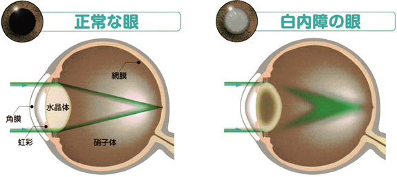 正常な眼と白内障の眼