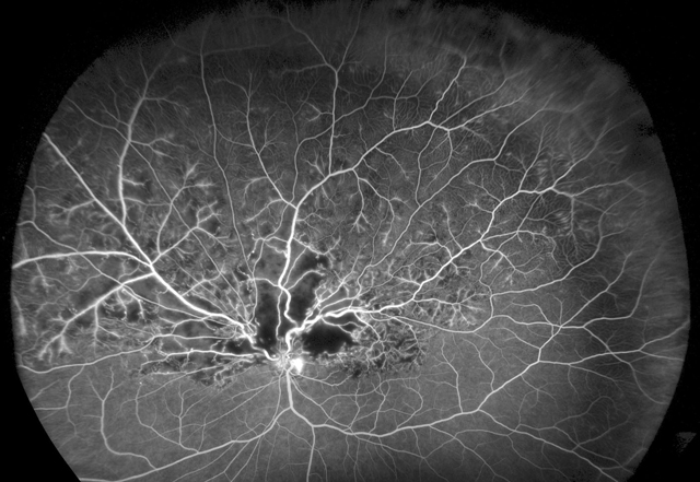 半側網膜静脈閉塞症の眼底写真（ｆａ）