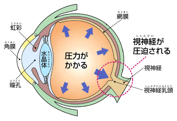 圧力が高くなることにより、視神経が圧迫されて発症する場合