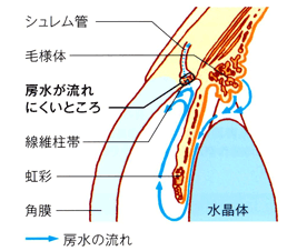 開放隅角緑内障