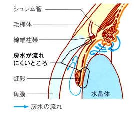 閉塞隅角緑内障