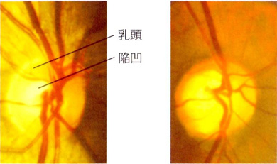 緑内障の初期