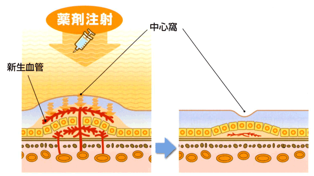 薬剤（ルセンティス）を眼内に注射